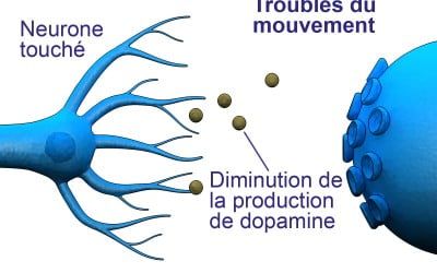 Parkinson : quand l’orthophonie aide les malades
