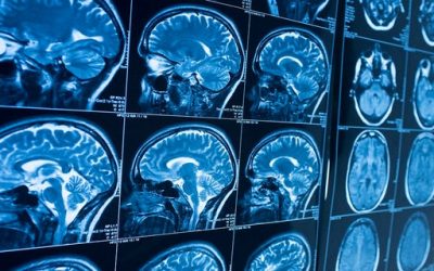 Dyslexie : plus de 40 gènes responsables de son apparition ont été identifiés